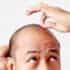 Hair Transplant in India Assures High Quality Result at Affordable Price